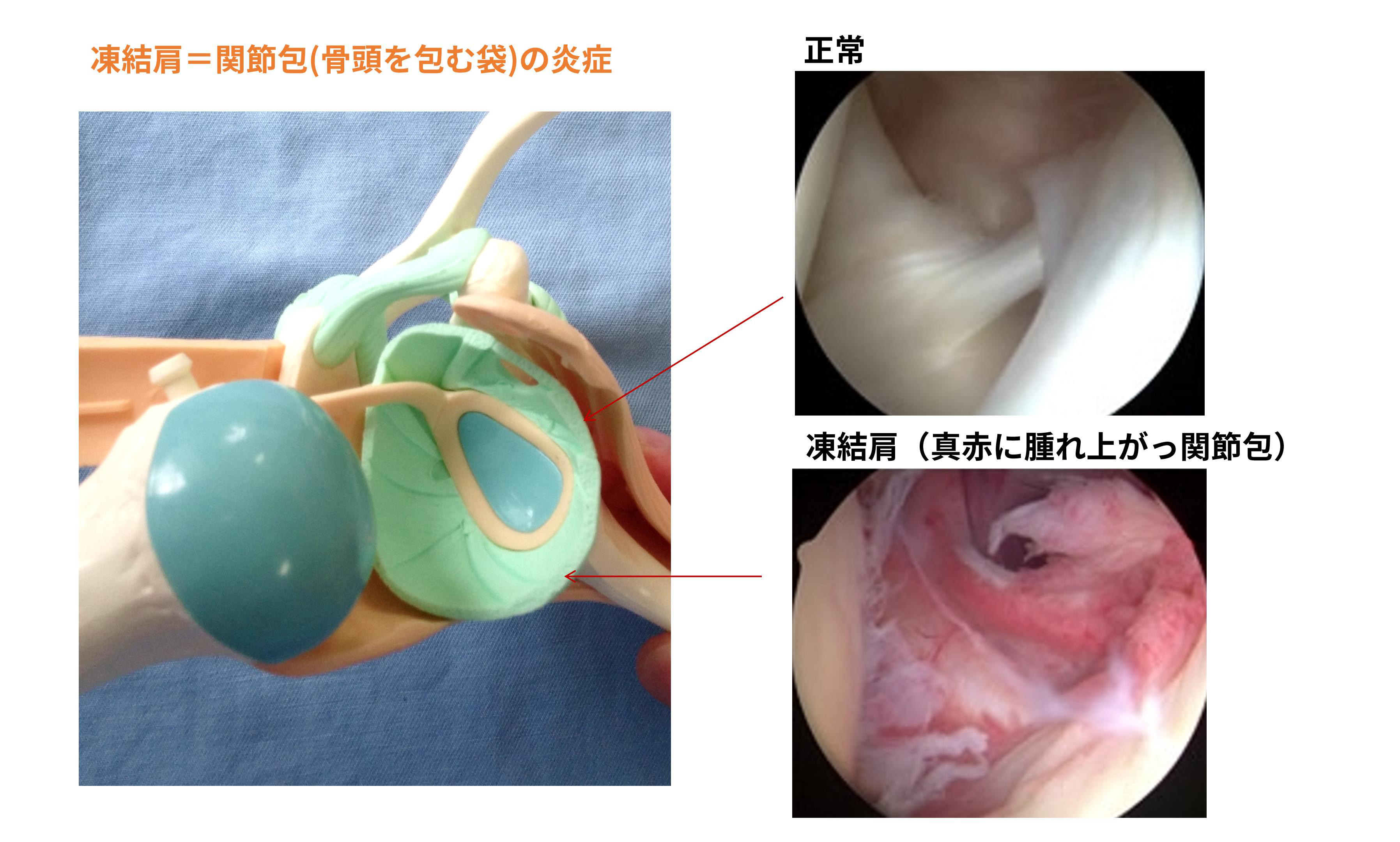 四十肩／五十肩とは