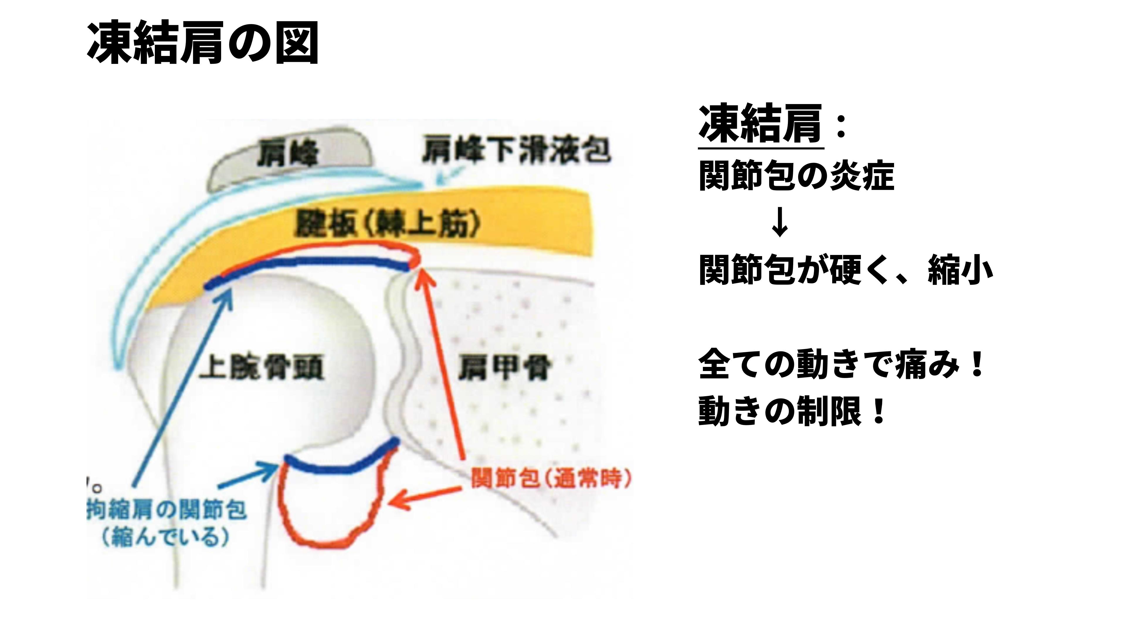 四十肩／五十肩とは