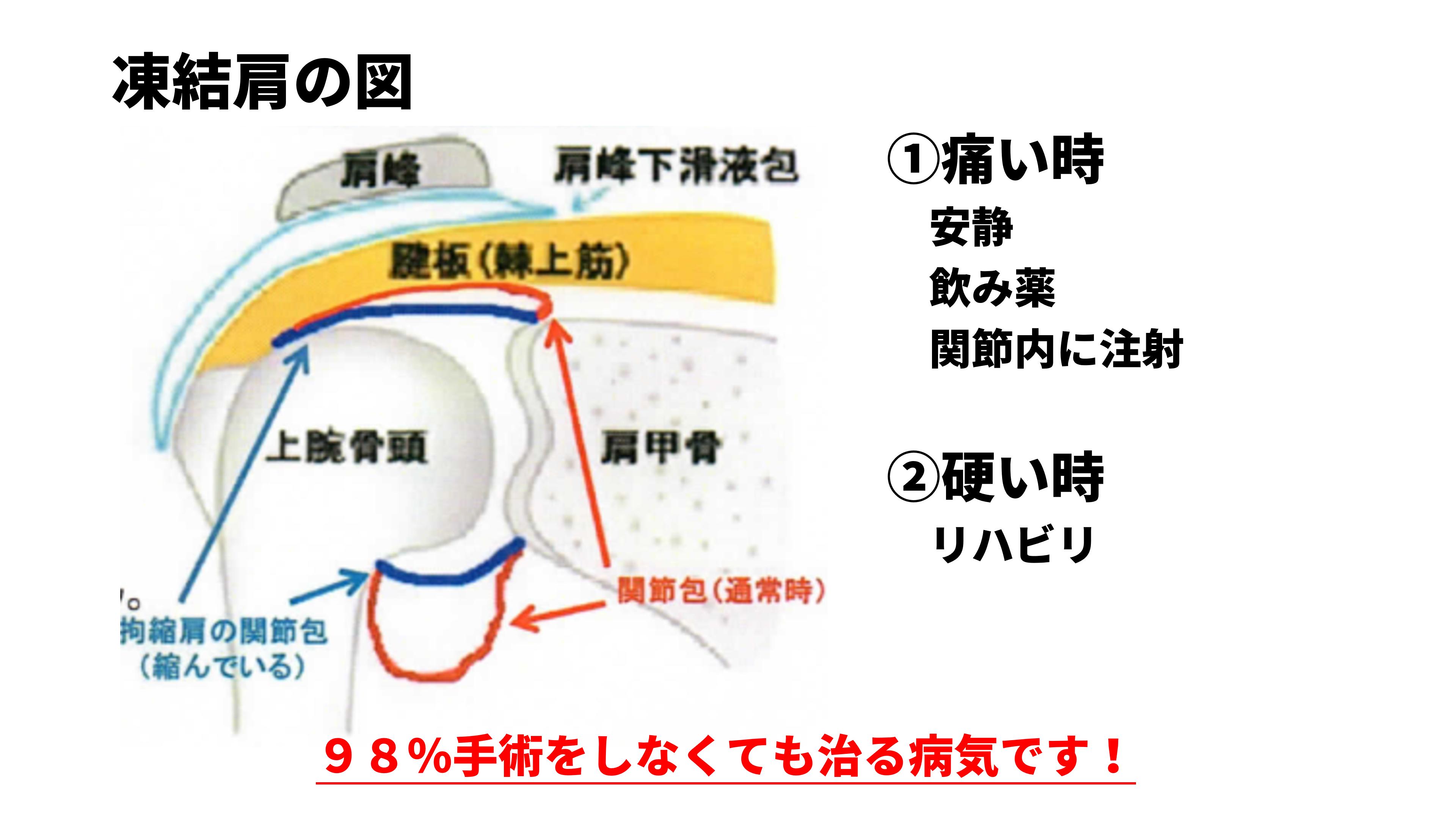 四十肩／五十肩とは