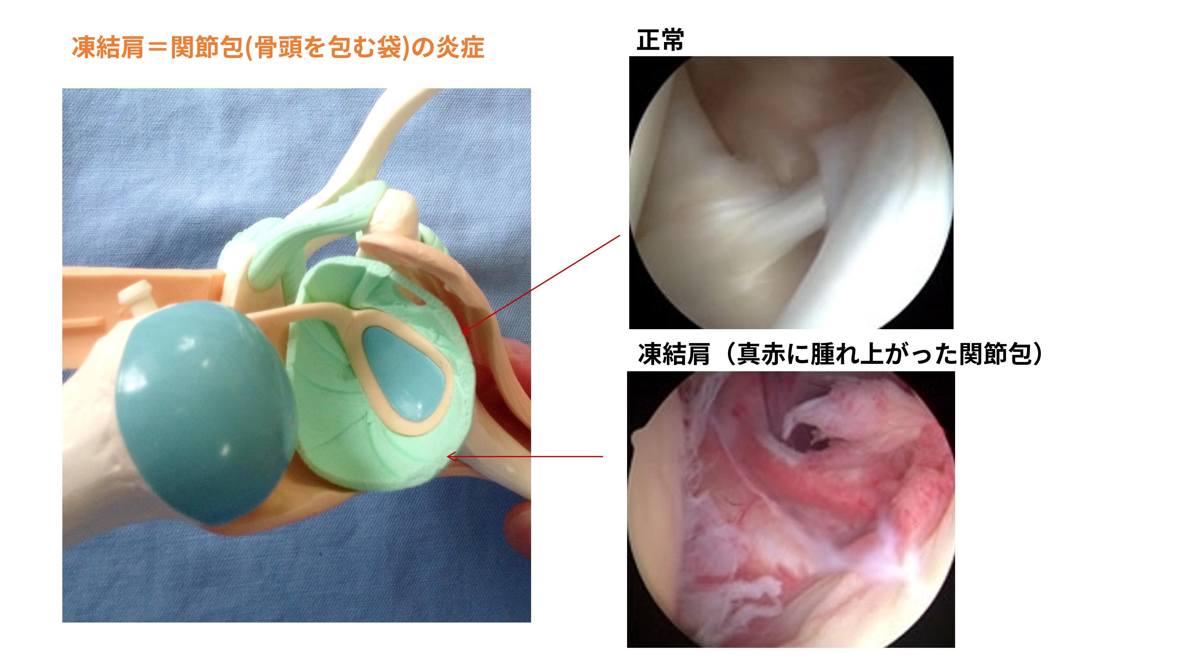 四十肩／五十肩とは